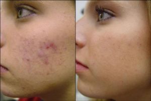 acne marks removal