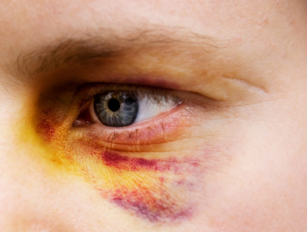 How To Get Rid Of A Black Eye how-to-get-rid-of-a-black-eye