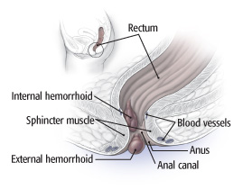 hemorrhoids removal